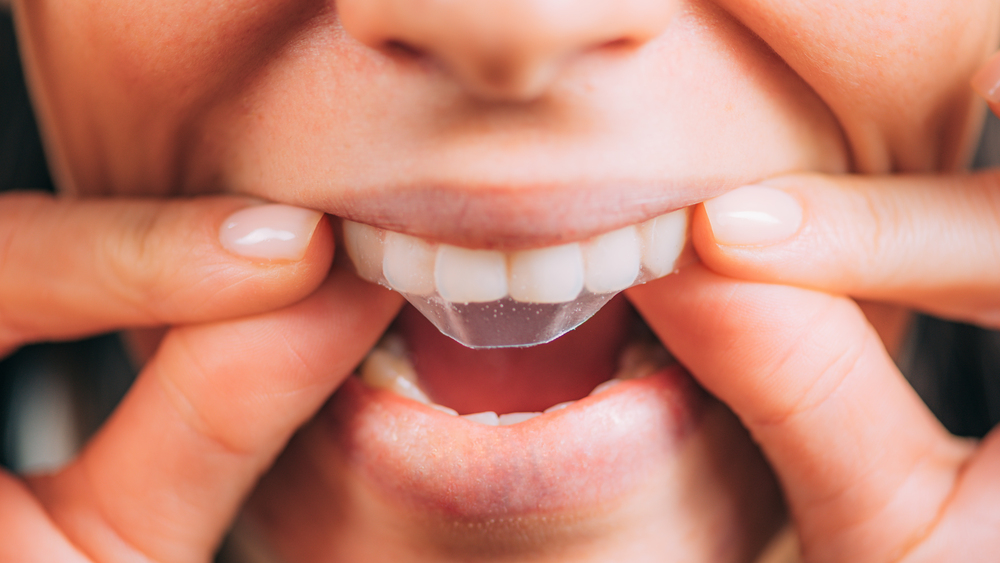 Person applying a clear tooth whitening strip to their upper teeth using both hands.