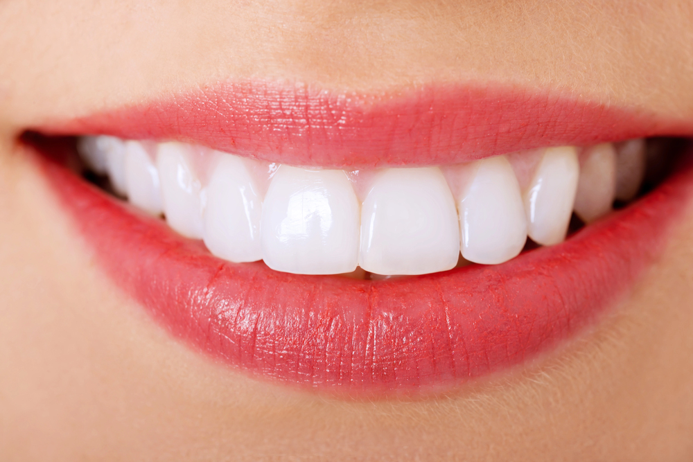 Close-up of a person's smile showing white teeth with veneers and pink lips.