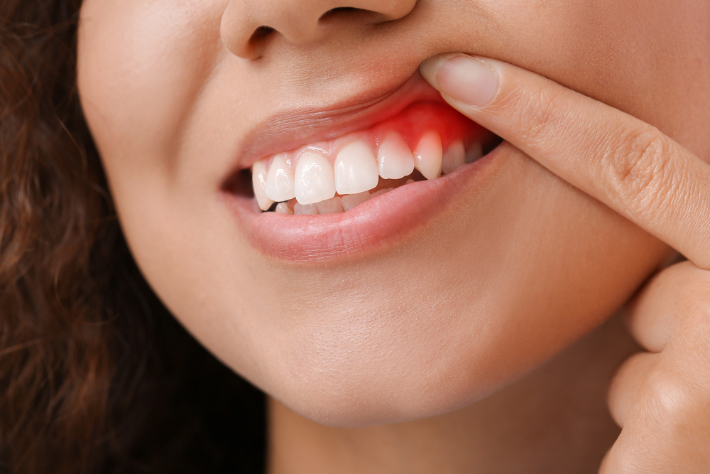 A person pulls up their upper lip to reveal red, inflamed gums, indicating possible gum irritation or gingivitis.