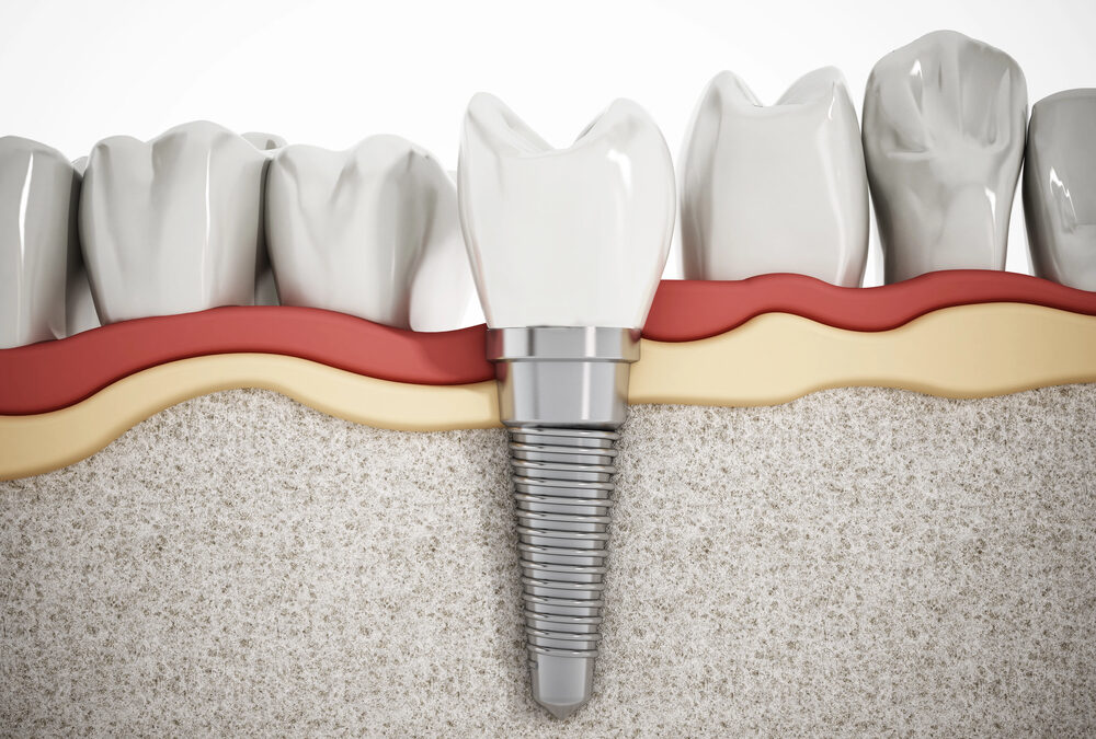 Cross-section illustration of a dental implant in a jawbone, showing the metal post, gum tissue, and adjacent natural teeth.