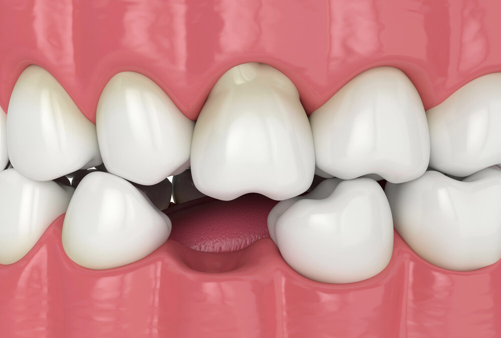 3D illustration of misaligned human teeth with an overbite and crowding, showing abnormal positioning of both upper and lower teeth within the gums.