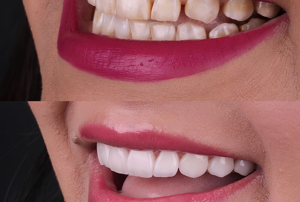 Close-up of a person's mouth comparing yellowish teeth before and bright white teeth after treatment by a cosmetic dentist.