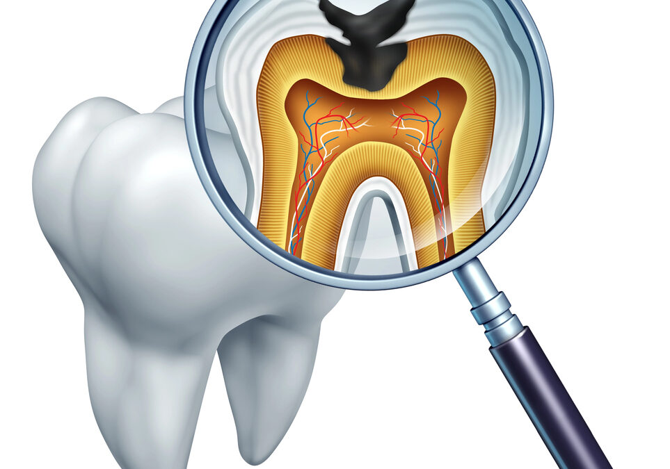 Magnifying glass reveals a cross-section of a tooth showing internal decay and cavity damage.