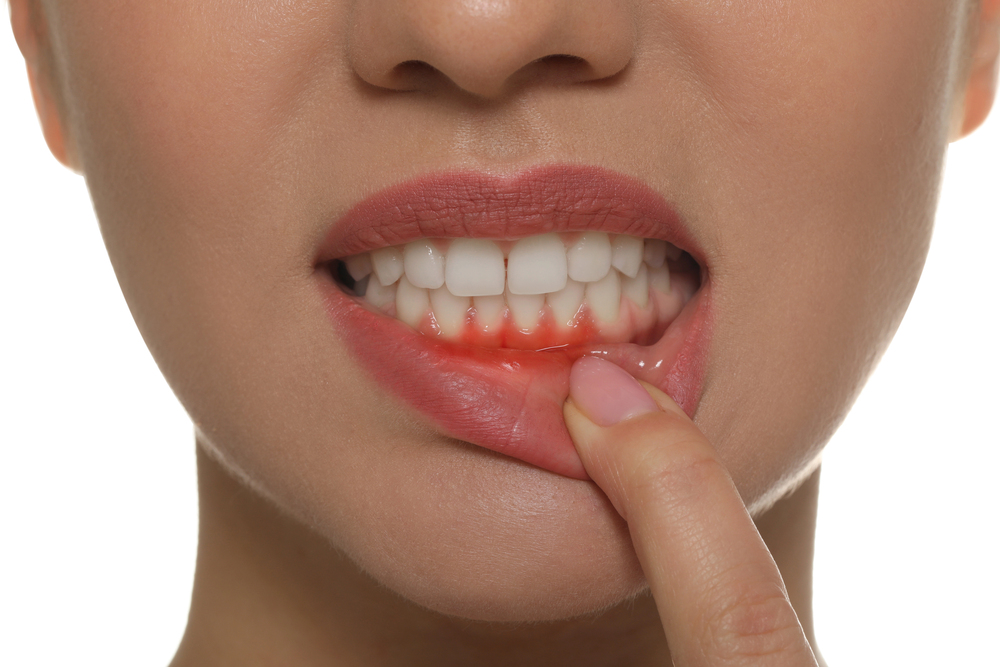 A person pulling down their lower lip to show red, inflamed gums, possibly indicating gum disease or irritation.