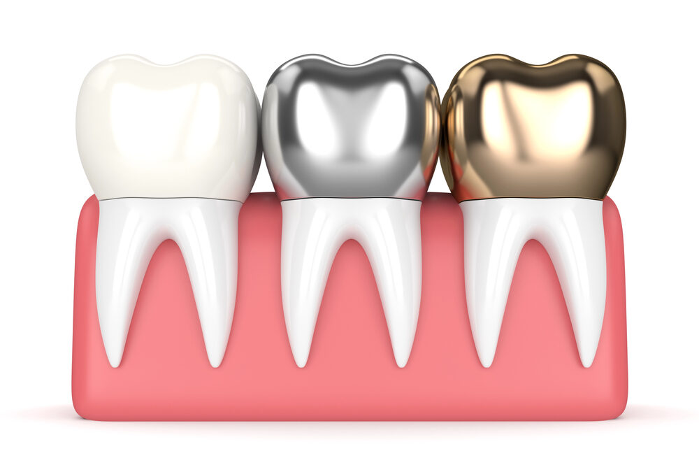 Three teeth with different crowns: one white, one silver, and one gold, set in a pink gum base, on a white background.